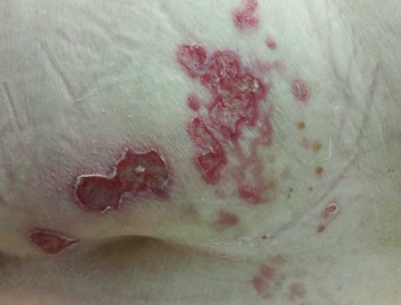 Recaída del herpes zóster en un paciente de 75 años con comorbilidades crónicas Imágen de portada