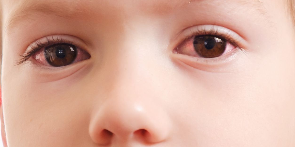 La uveítis pediátrica aumenta el riesgo de trastornos inflamatorios mediados por el sistema inmunitario Imágen de portada