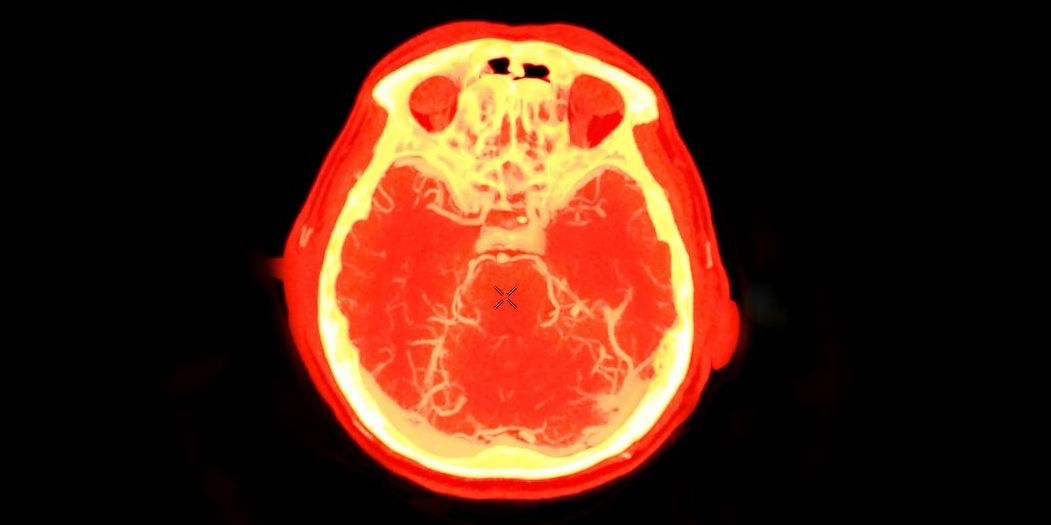 Exposición a opioides durante el embarazo se asocia con alteraciones del plegamiento cortical del recién nacido Imágen de portada