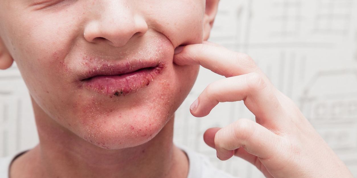 Infecciones tempranas en la infancia elevan el riesgo de dermatitis atópica Imágen de portada